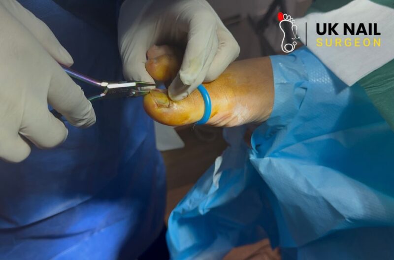 Relief for Toenail Pain: Safe, Effective Care Options