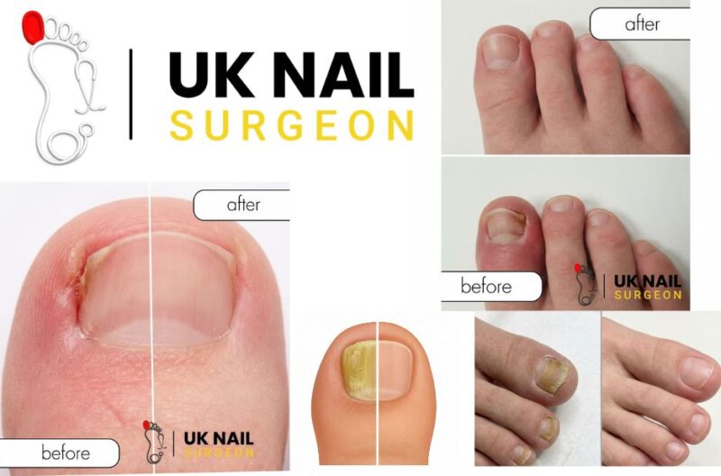 Nail Health: Expert Treatment for Fungal Infections and Nail Pain