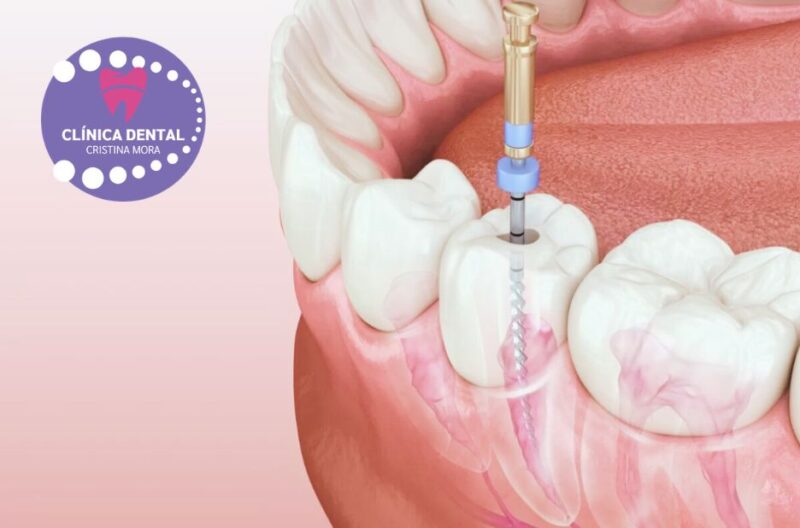 Sorrisos secs: Ortodòncia discreta a Gines per a un resultat immillorable