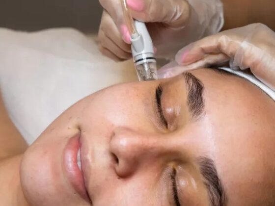 Expert Milia Treatment in Oakville for Clear Skin