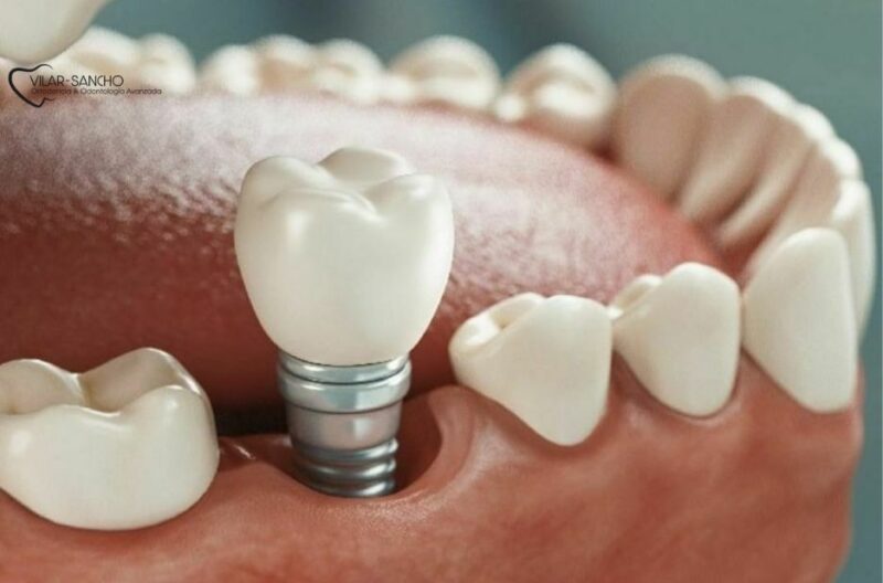 Top Pozuelo Dental Clinic for Your Smile Needs
