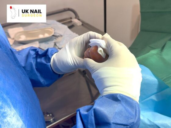 Toe Nail Procedures: Expert Care for Painful Nails and Infections