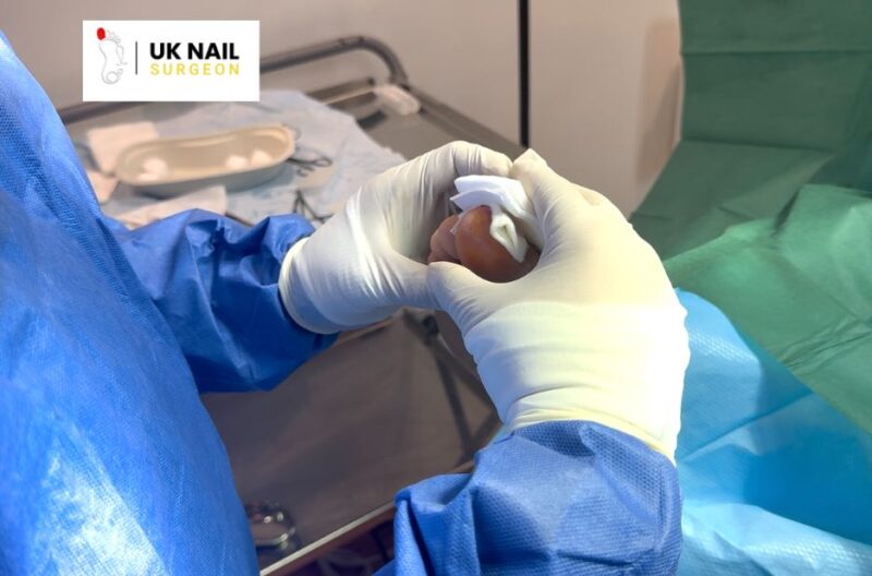 Toe Nail Procedures: Expert Care for Painful Nails and Infections