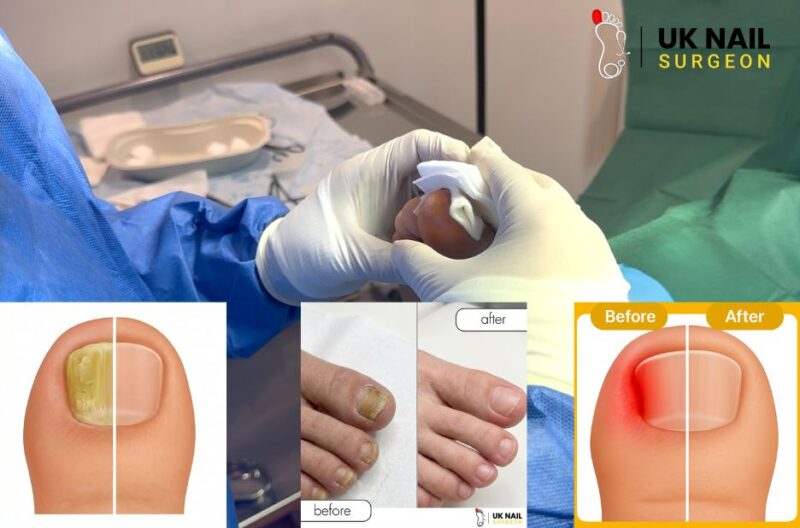 Professional Ingrown Toenail Removal Services for Safe and Lasting Relief
